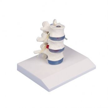 Lumbar Vertebrae with Prolapsed Inter Vertebral Discs with Stand