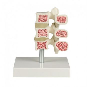 Osteoporosis Vertebrae Model - 3 Vertebrae