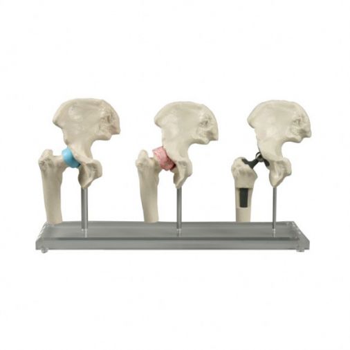Hip Implant Model