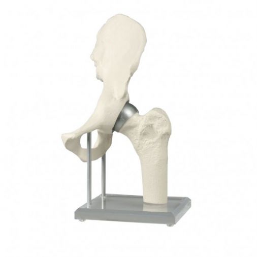 Hip Joint Model with Resurfacing Implant